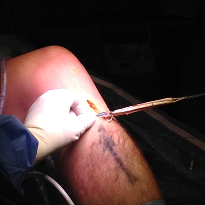 PICTURE OF AN ACL RECONSTRUCTION GRAFT DURING SURGERY

